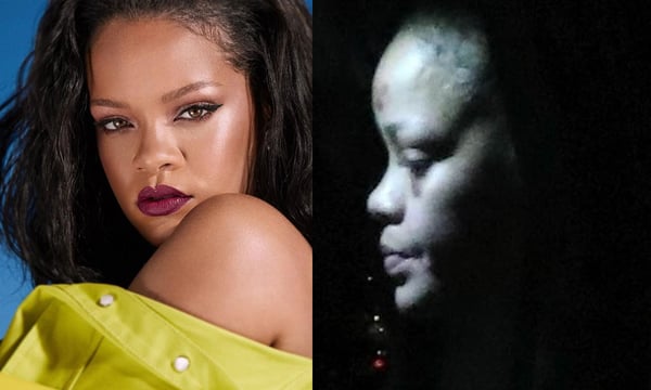 Rihanna confirma que sofreu acidente após cair de patinete elétrico