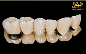 Nha khoa An Khánh, bọc răng sứ thẩm mỹ mang lại nụ cười tự tin!