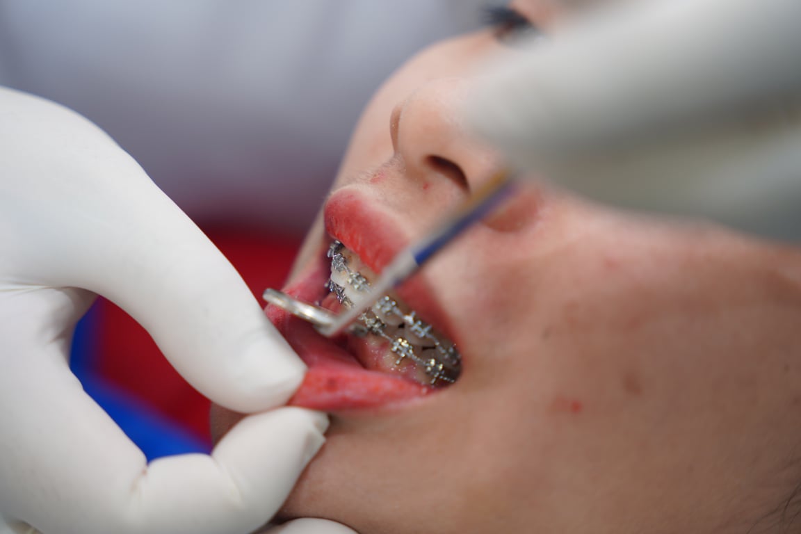 Kinh Nghiệm Niềng Răng - Những Điều Cần Biết Trước Khi Niềng