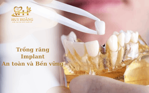 Nha khoa An Khánh, trồng răng Implant an toàn và bền vững