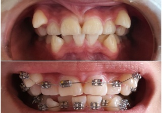 Tình trạng răng khấp khểnh