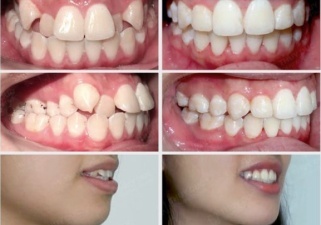 Tình trạng răng khấp khểnh