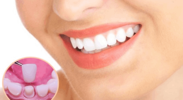 Bọc răng sứ thẩm mỹ