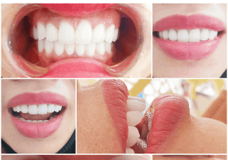 Tình trạng răng khấp khểnh