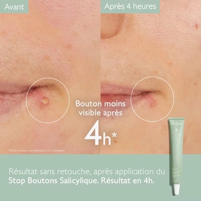 Vinopure Stop Boutons Salicylique - Image 2