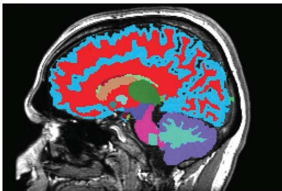 Brain scan measures aging rate