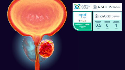 Prostate Cancer - Focal Therapy RACGP CPD Home Activity