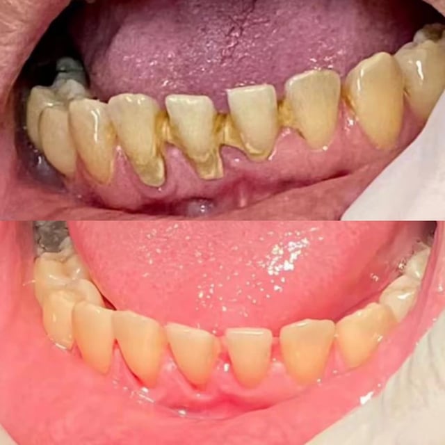 Antes e depois de tratamento odontológico realizado pelo Dr. Kleber Sandim — caso 4