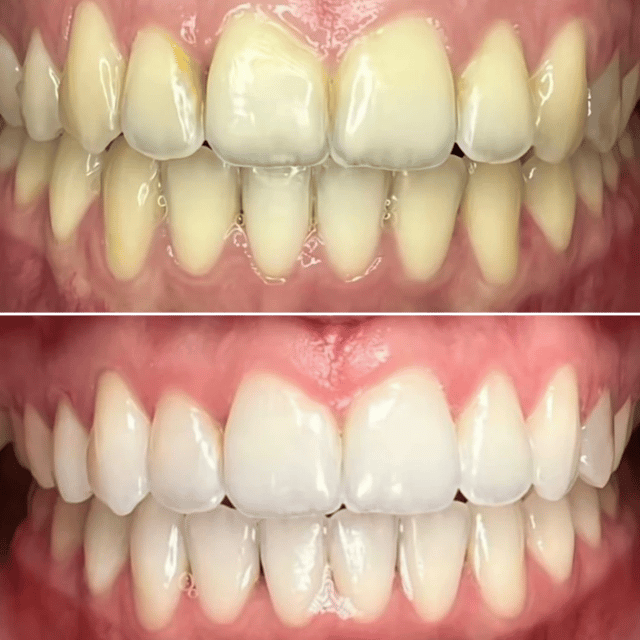 Antes e depois de tratamento odontológico realizado pelo Dr. Kleber Sandim — caso 3