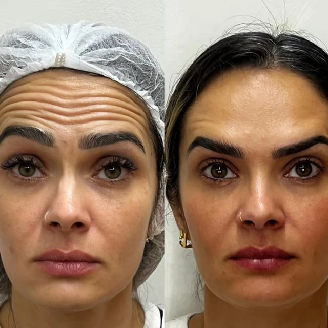 Antes e depois de tratamento odontológico realizado pelo Dr. Kleber Sandim — caso 5