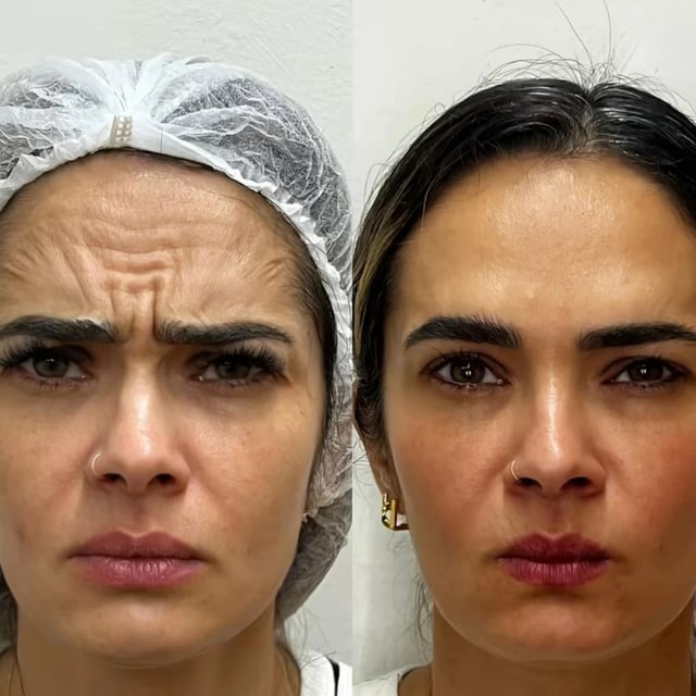 Antes e depois de tratamento odontológico realizado pelo Dr. Kleber Sandim — caso 7