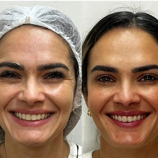 Antes e depois de tratamento odontológico realizado pelo Dr. Kleber Sandim — caso 6