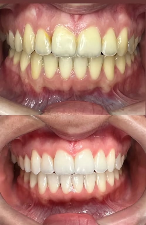 Antes e depois de tratamento realizado na Vértice — Dr. Kleber Sandim