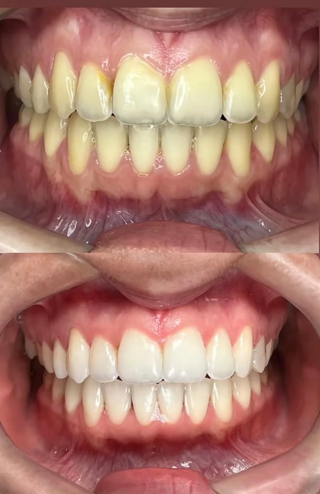 Antes e depois de tratamento odontológico realizado pelo Dr. Kleber Sandim — caso 1