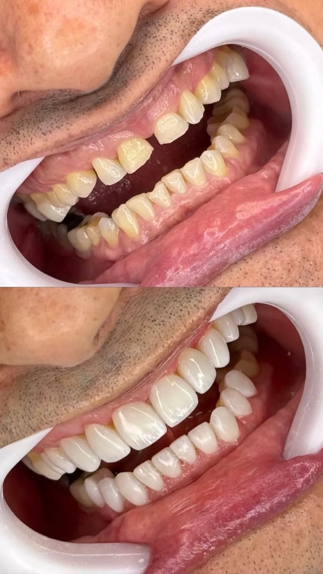 Antes e depois de tratamento odontológico realizado pelo Dr. Kleber Sandim — caso 2