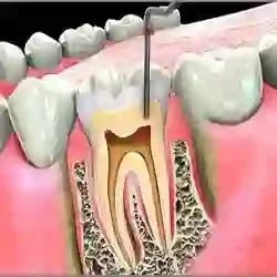 Endodontic Services