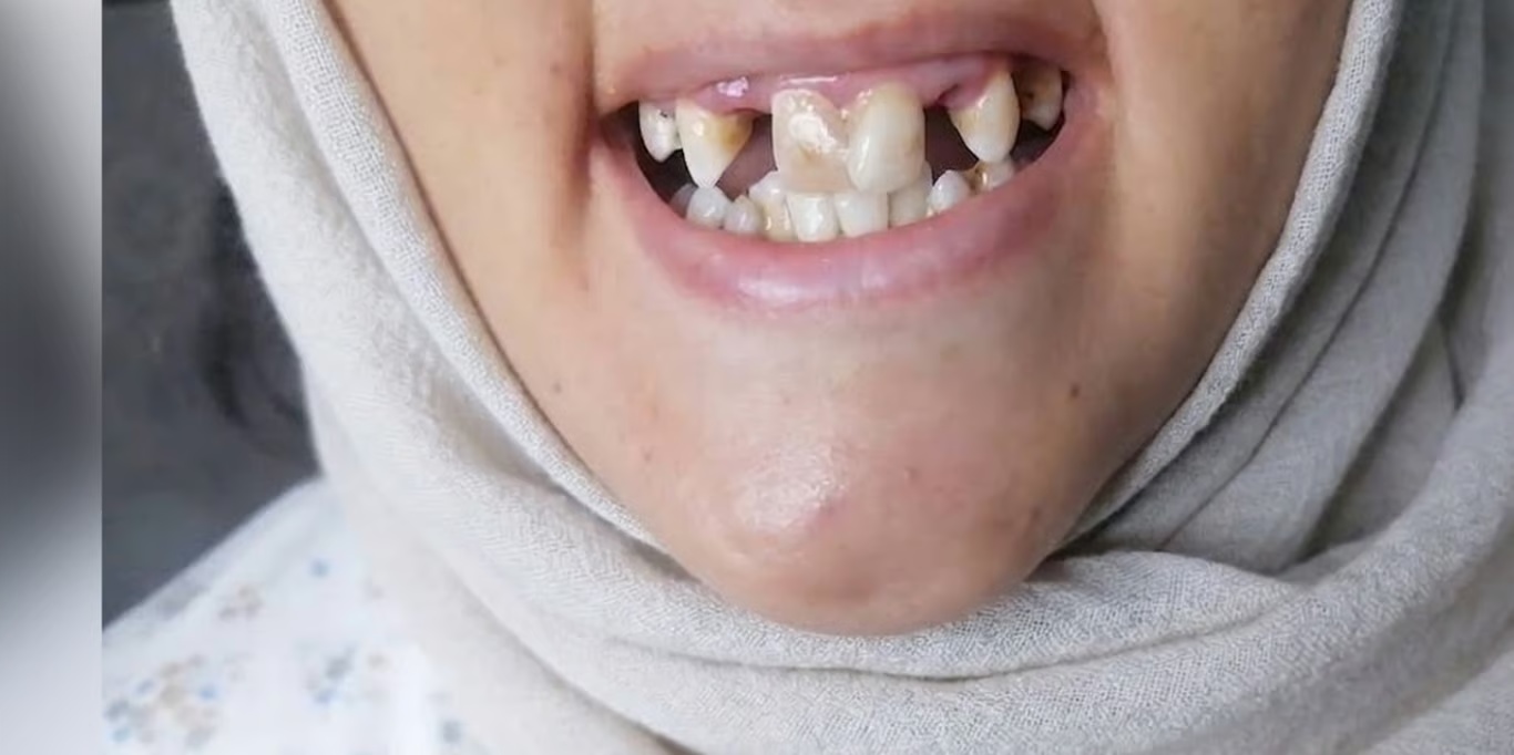 Smile with missing teeth