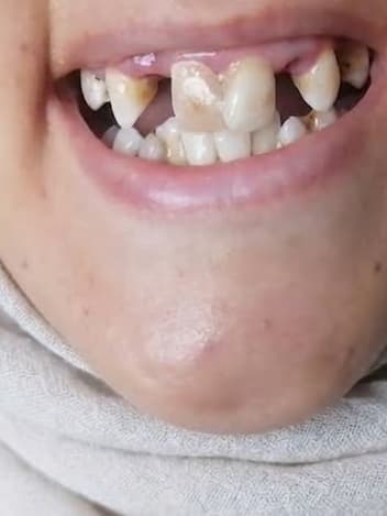 Smile with missing teeth