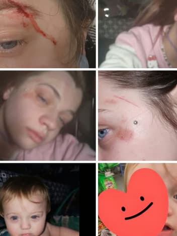 Kvinna som fotograferar sina skador som bevis