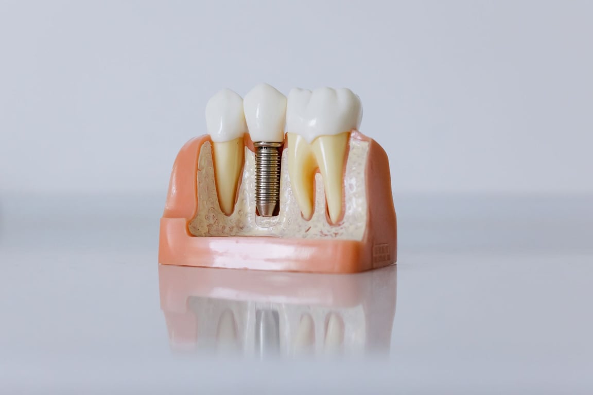 How to get help with dental implants