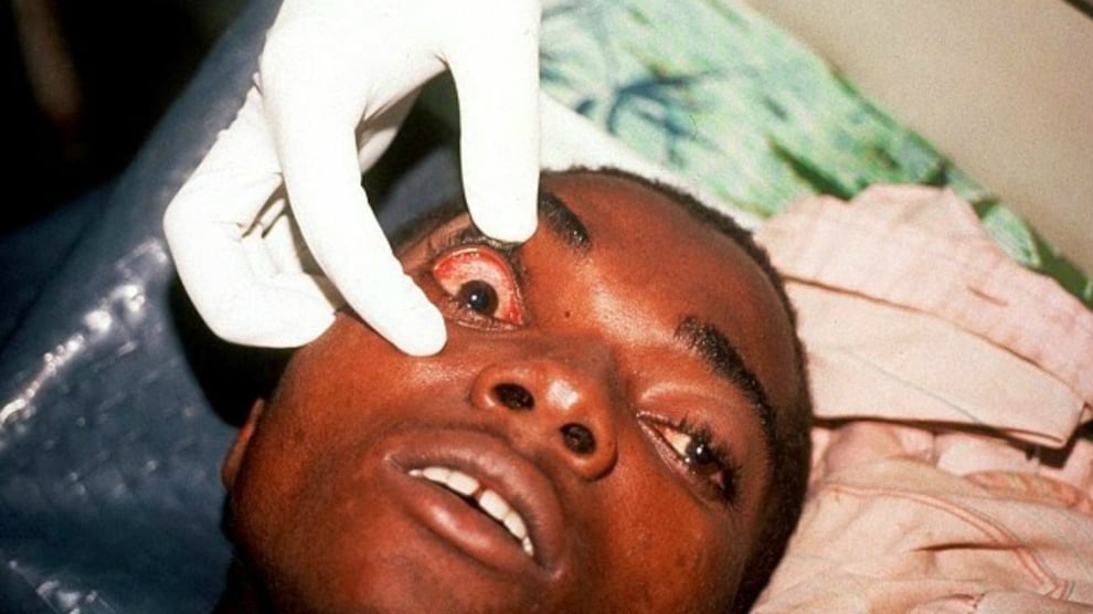 Nigeria At Risk Of Marburg Virus — NCDC