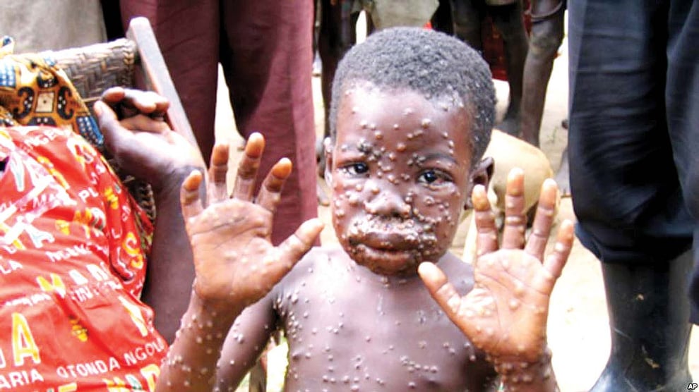 Nigeria Records Six Cases Of Monkeypox In May 2022