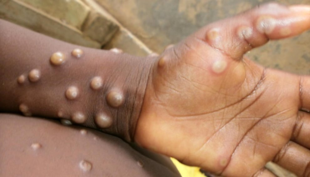 Monkeypox: WHO Expecting More Cases Globally