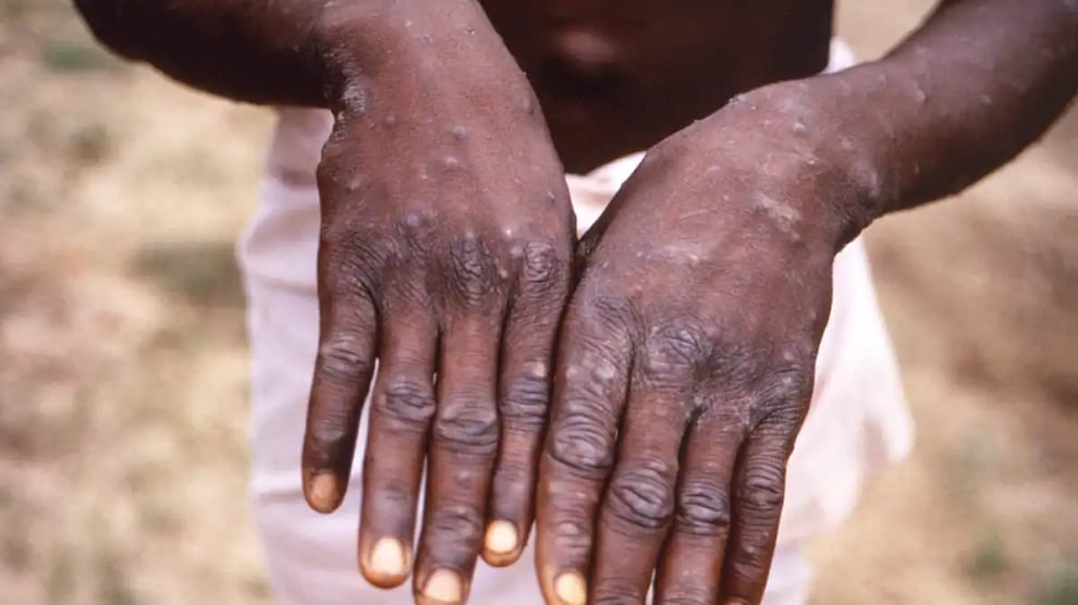 Katsina Records First Monkeypox Case