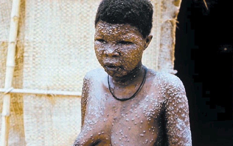 Monkeypox: Nigeria Records 49 Confirmed Cases, No New Death