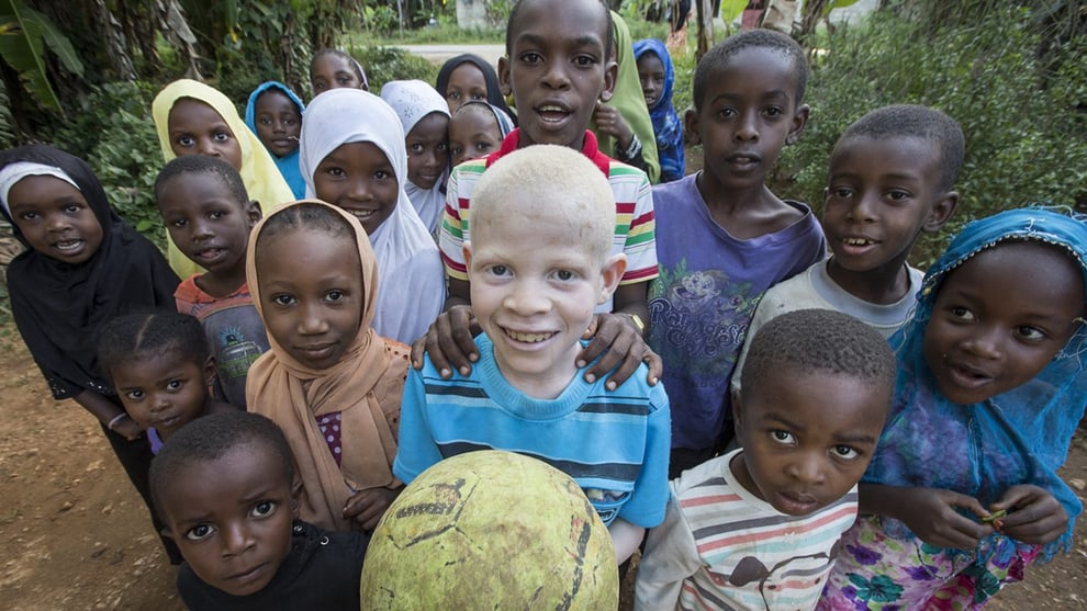 Albinism: Facing Discrimination And Plagued By Cruel Myths