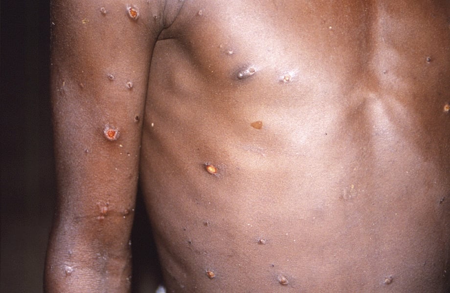Nigeria Has Highest Monkeypox Death Toll In Africa, Says WHO