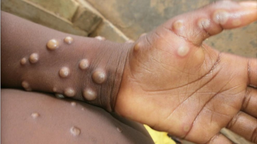 Ebonyi: One Of 32 Suspected Monkeypox Cases Confirmed