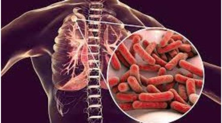 World Tuberculosis Day: Need For Awareness, Eradication Emph