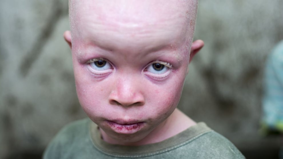 Group Seeks Free Treatment Of Skin Cancer For Albinos
