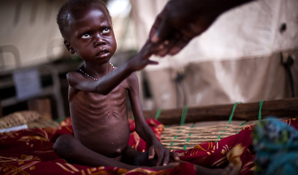 Malnutrition Worsens As Food Prices Soar In Sudan