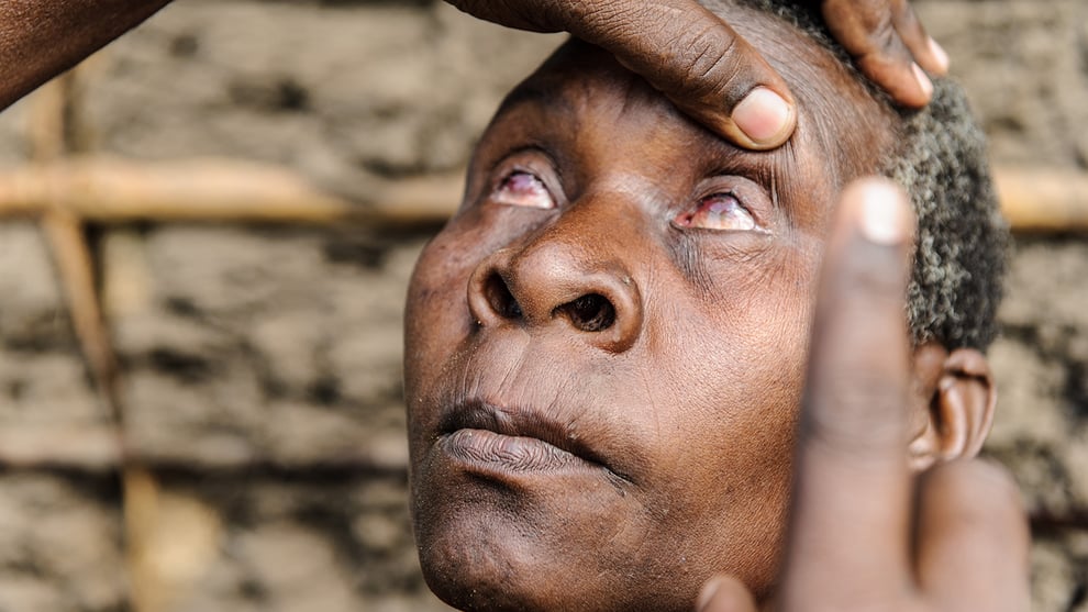 Malawi Has Eliminated Blinding Trachoma Disease - WHO