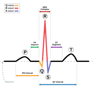 ST Segment on ECG Trace track