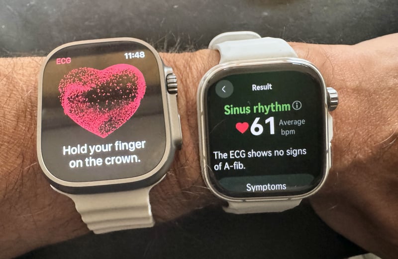 Huawei Watch Fit 5 Pro ECG test showing normal sinus rhythm validated against Apple Watch Ultra 3