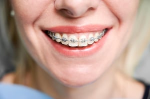 Imagem do produto Aparelho Fixo para Corrigir os Dentes