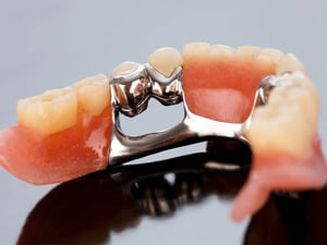 Imagem do produto Prótese Dentária Esquelética Removível – Conforto e Estabilidade