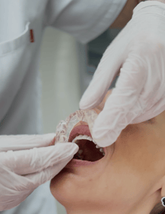 Imagem do produto Placa Miorrelaxante em Acrílico para Bruxismo ou Tensão Mandibula