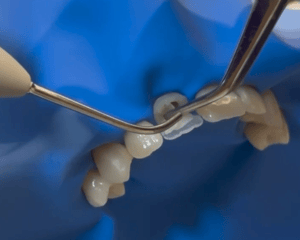 Imagem do produto Reconstrução Dentária com Espigões para Retenção Adicional
