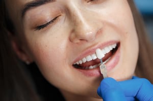 Imagem do produto Facetas Dentárias de Porcelana para Um Sorriso Perfeito