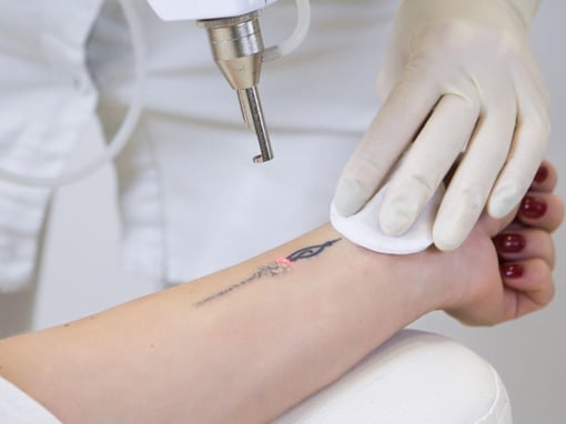 Remoção de Tatuagens: Elimine Tatoo Indesejadas com Segurança