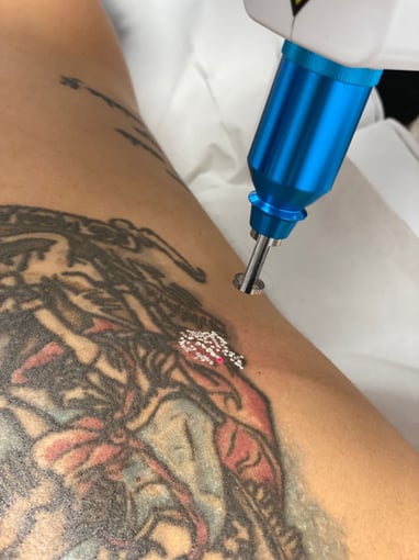 Remoção da Tatuagem a Laser
