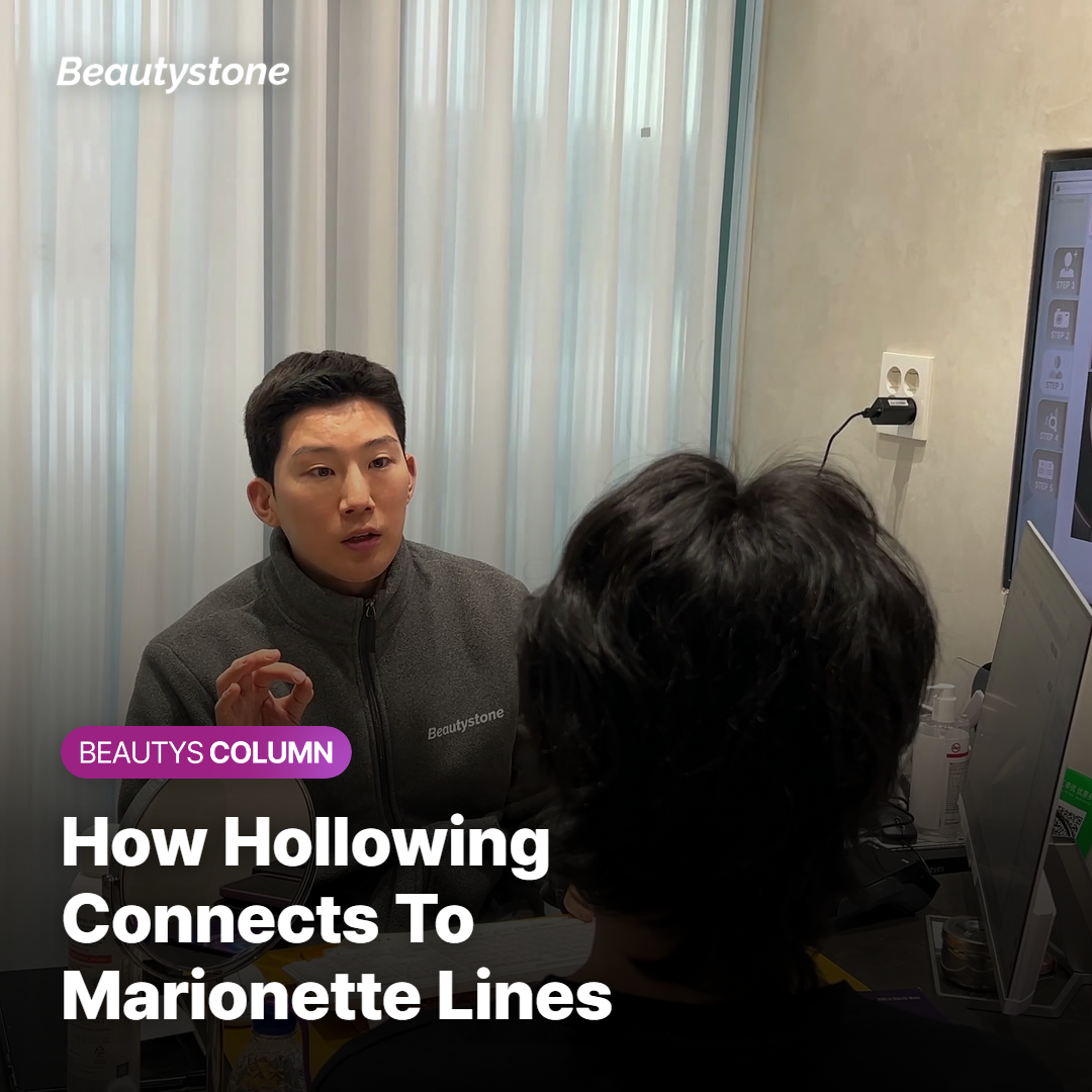 Connection between perioral hollowing and marionette lines