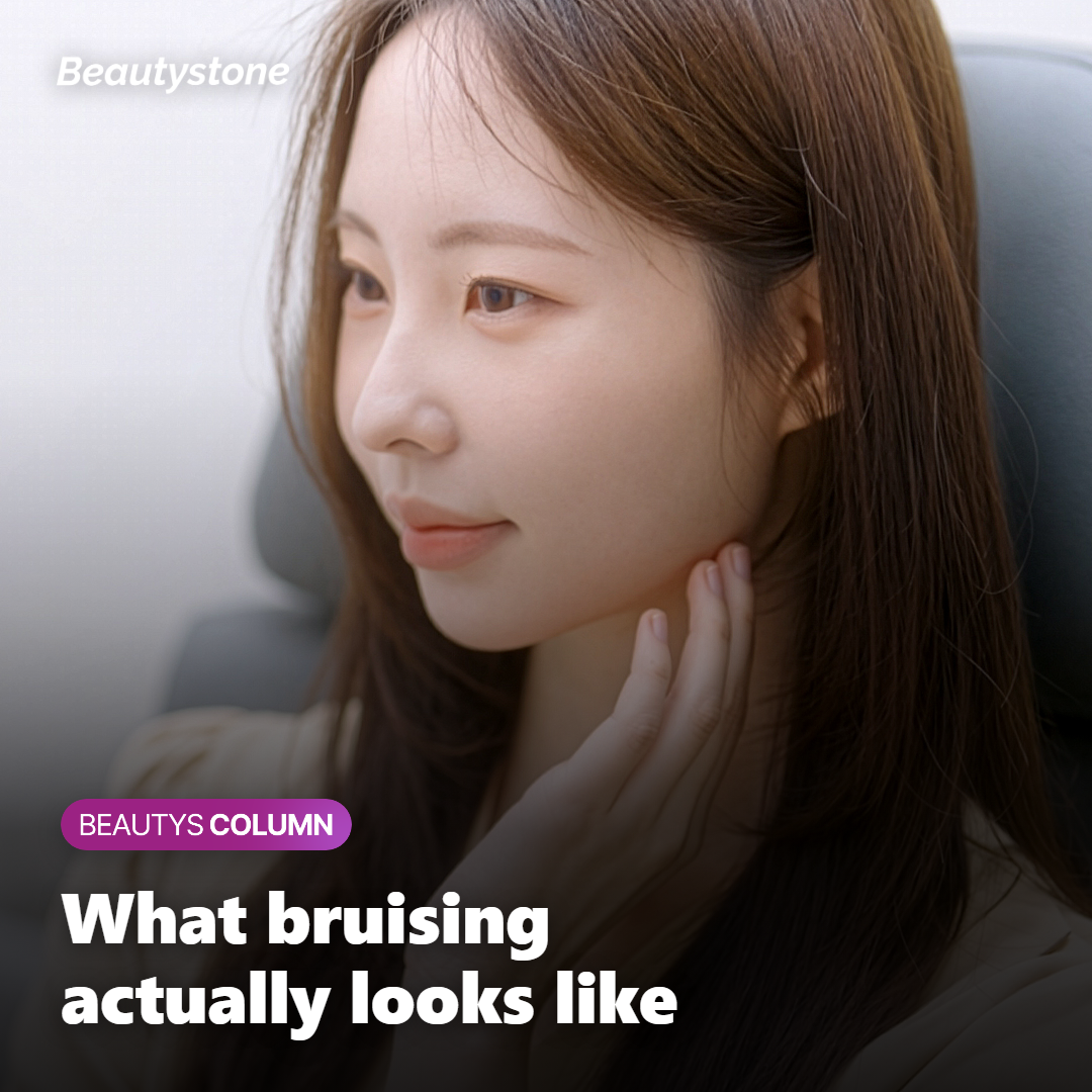 Typical bruising and swelling after treatment while taking blood-thinning medication