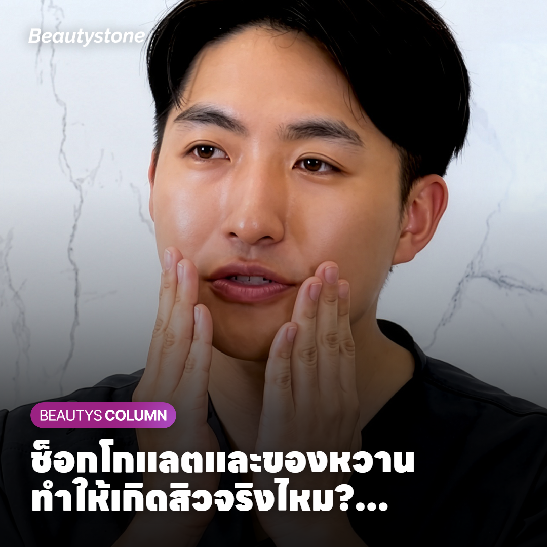 ช็อกโกแลตและของหวานทำให้เกิดสิวจริงไหม? คุณหมอเผยความจริงที่หลายคนเข้าใจผิด