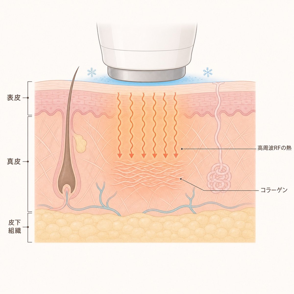 高周波RFの熱が真皮に届き、コラーゲンの収縮と再生を促す仕組みの断面図