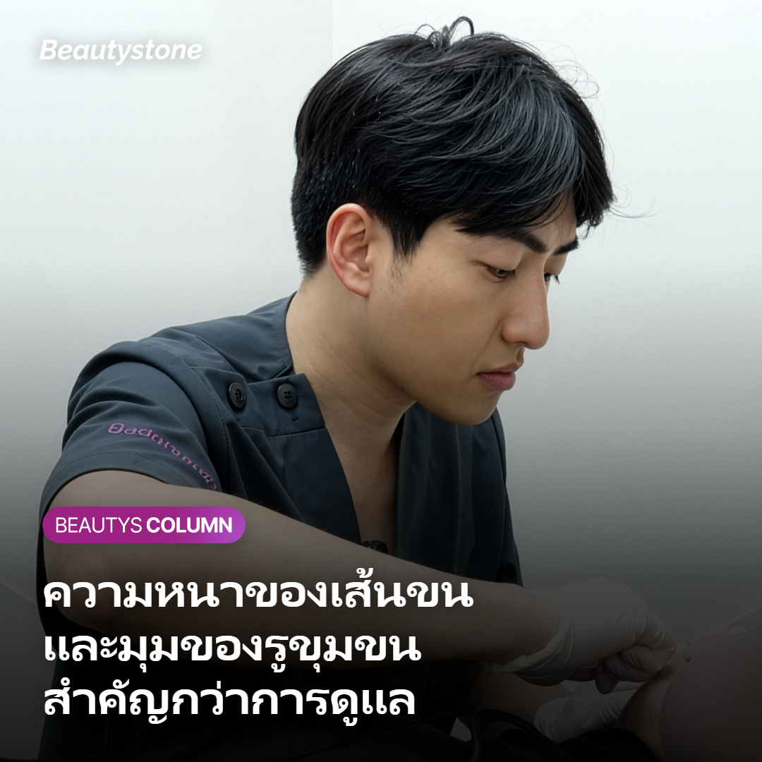 ภาพตัดขวางแสดงเส้นขนหนาที่ย้อนกลับเข้าผิวเมื่อรูขุมขนวางตัวเอียงราบ